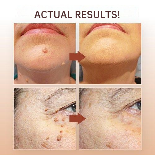 Dermapoint - Gezielter Stift zur Entfernung von Hautanhängseln