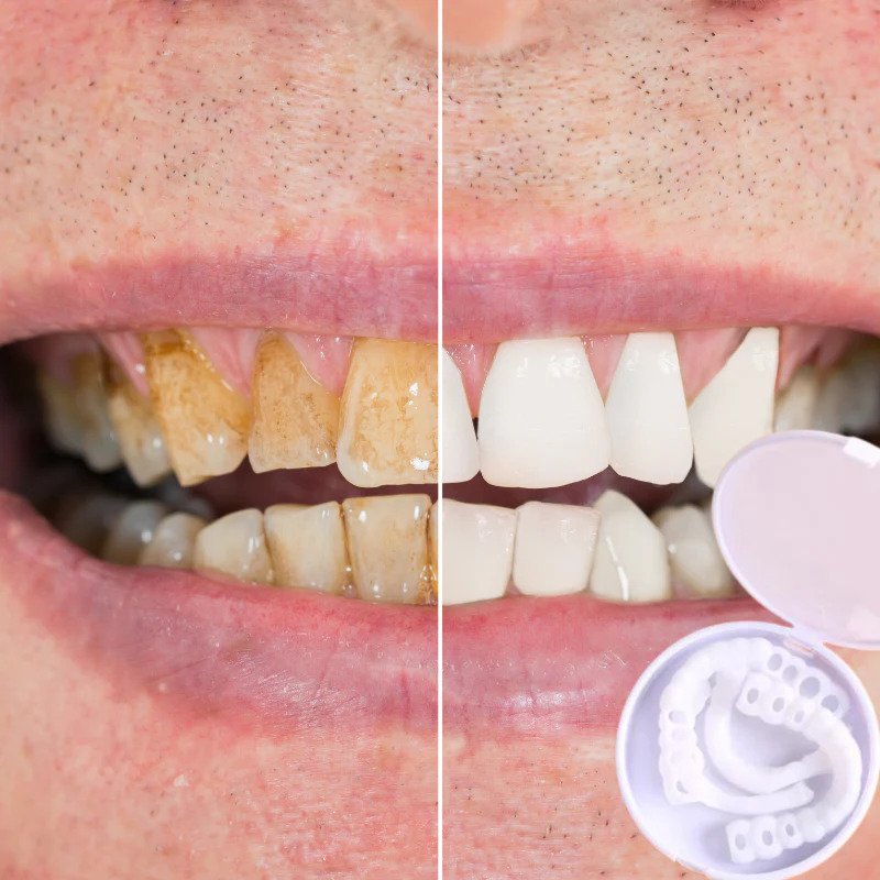 Dentasnap - Kosmetische Schnapp-Veneers