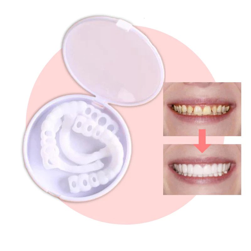 Dentasnap - Kosmetische Schnapp-Veneers