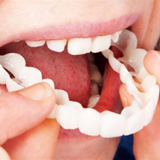 Dentasnap - Kosmetische Schnapp-Veneers