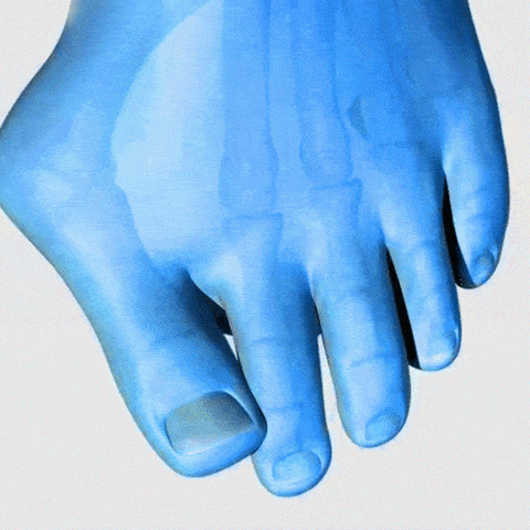 Alignica - Flexible Korrekturbandage bei Hallux valgus