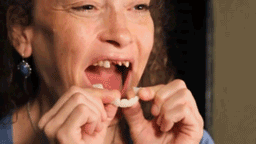 Dentasnap - Kosmetische Schnapp-Veneers