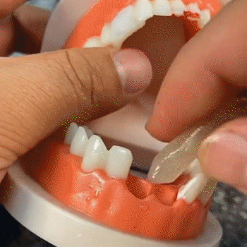SmileFill - Formbares Set zur vorübergehenden Zahnreparatur