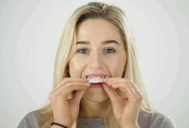 Dentasnap - Kosmetische Schnapp-Veneers