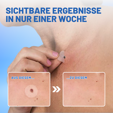 Blemisoothe - Gezielte Warzenentferner-Pflaster