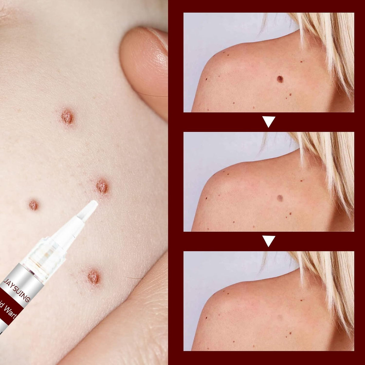 Dermapoint - Gezielter Stift zur Entfernung von Hautanhängseln