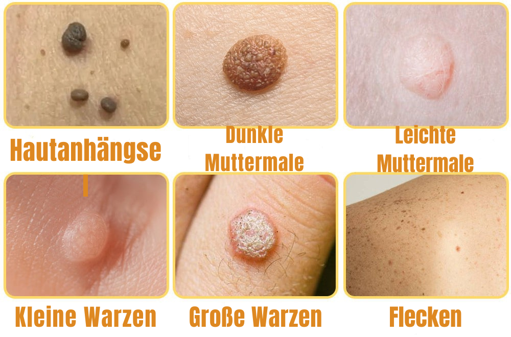 DermClear - Flüssiges Spray zur Entfernung von Hautanhängseln