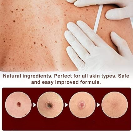 Dermapoint - Gezielter Stift zur Entfernung von Hautanhängseln
