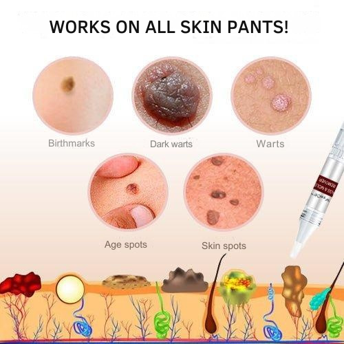 Dermapoint - Gezielter Stift zur Entfernung von Hautanhängseln
