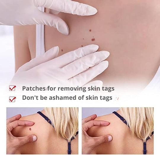 Dermapoint - Gezielter Stift zur Entfernung von Hautanhängseln