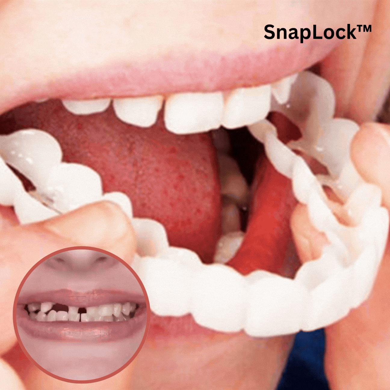 DentSnap - Herausnehmbare provisorische Zahnverblendungen
