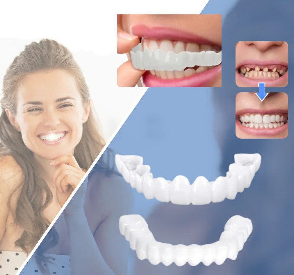 Dentasnap - Kosmetische Schnapp-Veneers