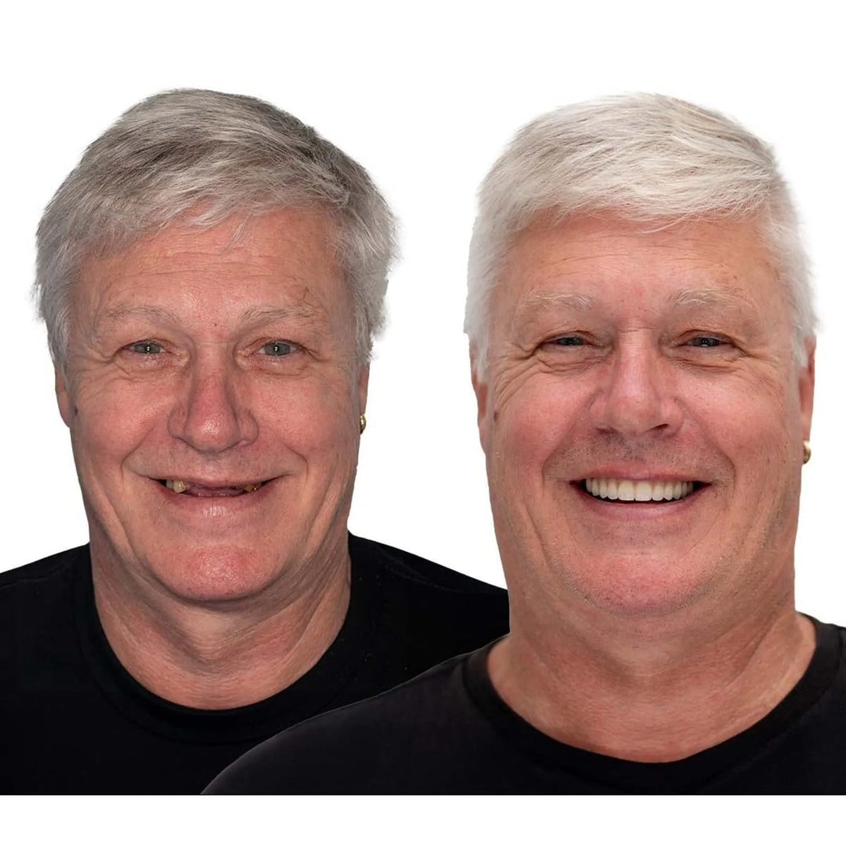 Removable Full Arch Denture Set with Flexible Cushion Grip